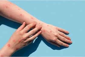 Bộ Y tế đề nghị tăng cường phòng, chống dịch bệnh đậu mùa khỉ