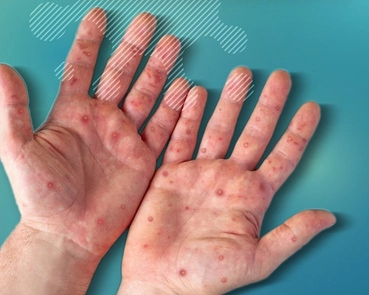 Hướng dẫn triệu chứng nghi ngờ bệnh đậu mùa khỉ và biện pháp phòng bệnh