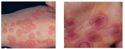 Quyết định 75/QĐ-BYT của Bộ Y tế về việc ban hành Tài liệu chuyên môn “Hướng dẫn chẩn đoán và điều trị các bệnh da liễu”