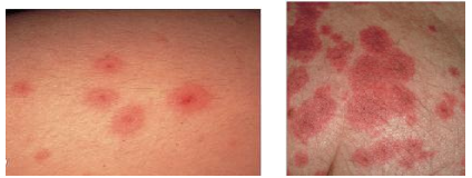 Quyết định 75/QĐ-BYT của Bộ Y tế về việc ban hành Tài liệu chuyên môn “Hướng dẫn chẩn đoán và điều trị các bệnh da liễu”