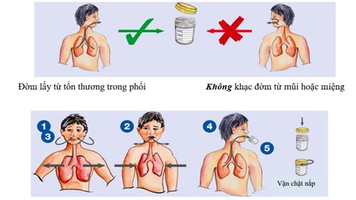 Quyết định 1314/QĐ-BYT của Bộ Y tế về việc ban hành Hướng dẫn chẩn đoán, điều trị và dự phòng bệnh lao