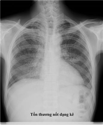 Quyết định 1314/QĐ-BYT của Bộ Y tế về việc ban hành Hướng dẫn chẩn đoán, điều trị và dự phòng bệnh lao