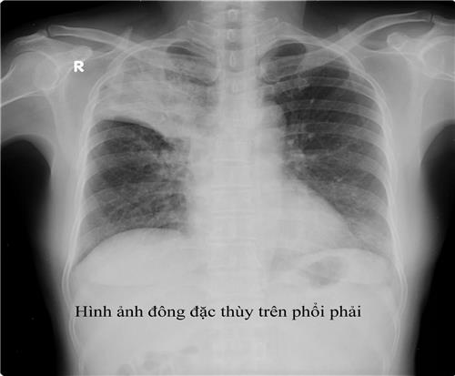 Quyết định 1314/QĐ-BYT của Bộ Y tế về việc ban hành Hướng dẫn chẩn đoán, điều trị và dự phòng bệnh lao