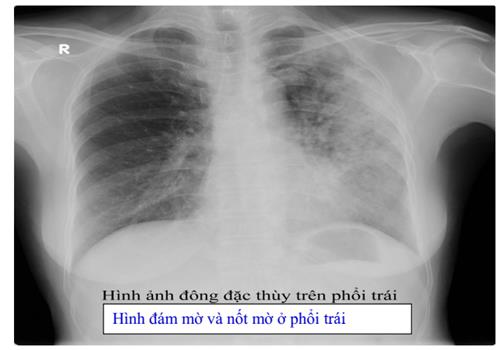Quyết định 1314/QĐ-BYT của Bộ Y tế về việc ban hành Hướng dẫn chẩn đoán, điều trị và dự phòng bệnh lao