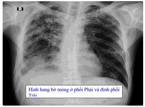 Quyết định 1314/QĐ-BYT của Bộ Y tế về việc ban hành Hướng dẫn chẩn đoán, điều trị và dự phòng bệnh lao