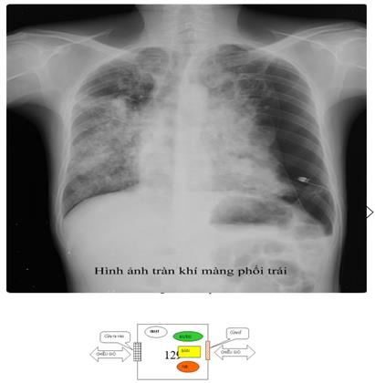 Quyết định 1314/QĐ-BYT của Bộ Y tế về việc ban hành Hướng dẫn chẩn đoán, điều trị và dự phòng bệnh lao