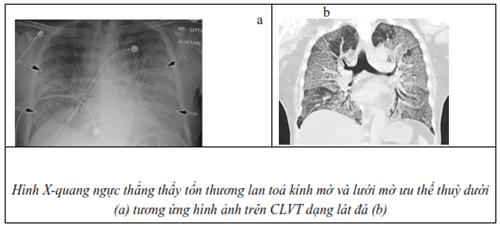 Quyết định 2671/QĐ-BYT của Bộ Y tế về việc ban hành Hướng dẫn chẩn đoán và điều trị COVID-19