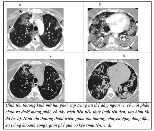 Quyết định 2671/QĐ-BYT của Bộ Y tế về việc ban hành Hướng dẫn chẩn đoán và điều trị COVID-19