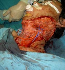 Quyết định 635/QĐ-BYT của Bộ Y tế về ban hành Hướng dẫn Quy trình kỹ thuật khám bệnh, chữa bệnh chuyên ngành Bỏng