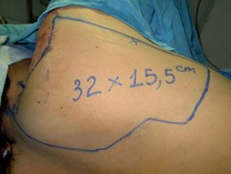 Quyết định 635/QĐ-BYT của Bộ Y tế về ban hành Hướng dẫn Quy trình kỹ thuật khám bệnh, chữa bệnh chuyên ngành Bỏng