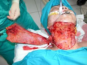 Quyết định 635/QĐ-BYT của Bộ Y tế về ban hành Hướng dẫn Quy trình kỹ thuật khám bệnh, chữa bệnh chuyên ngành Bỏng