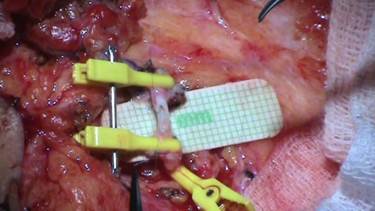 Quyết định 635/QĐ-BYT của Bộ Y tế về ban hành Hướng dẫn Quy trình kỹ thuật khám bệnh, chữa bệnh chuyên ngành Bỏng