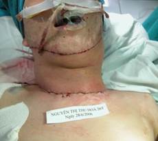 Quyết định 635/QĐ-BYT của Bộ Y tế về ban hành Hướng dẫn Quy trình kỹ thuật khám bệnh, chữa bệnh chuyên ngành Bỏng