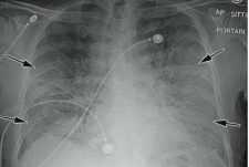 Quyết định 4689/QĐ-BYT của Bộ Y tế về việc ban hành Hướng dẫn chẩn đoán và điều trị COVID-19