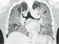 Quyết định 4689/QĐ-BYT của Bộ Y tế về việc ban hành Hướng dẫn chẩn đoán và điều trị COVID-19