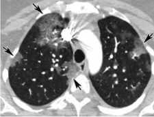 Quyết định 4689/QĐ-BYT của Bộ Y tế về việc ban hành Hướng dẫn chẩn đoán và điều trị COVID-19