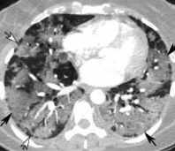 Quyết định 4689/QĐ-BYT của Bộ Y tế về việc ban hành Hướng dẫn chẩn đoán và điều trị COVID-19