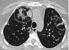 Quyết định 4689/QĐ-BYT của Bộ Y tế về việc ban hành Hướng dẫn chẩn đoán và điều trị COVID-19