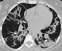 Quyết định 4689/QĐ-BYT của Bộ Y tế về việc ban hành Hướng dẫn chẩn đoán và điều trị COVID-19