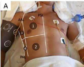 Quyết định 4689/QĐ-BYT của Bộ Y tế về việc ban hành Hướng dẫn chẩn đoán và điều trị COVID-19