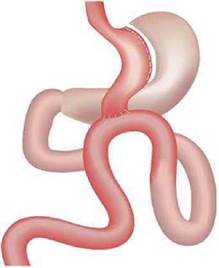 Quyết định 2892/QĐ-BYT của Bộ Y tế về việc ban hành Tài liệu chuyên môn “Hướng dẫn chẩn đoán và điều trị bệnh béo phì”