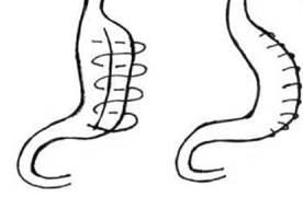 Quyết định 2892/QĐ-BYT của Bộ Y tế về việc ban hành Tài liệu chuyên môn “Hướng dẫn chẩn đoán và điều trị bệnh béo phì”