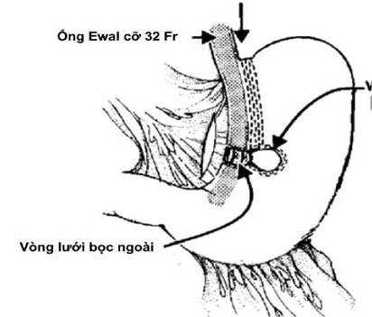 Quyết định 2892/QĐ-BYT của Bộ Y tế về việc ban hành Tài liệu chuyên môn “Hướng dẫn chẩn đoán và điều trị bệnh béo phì”